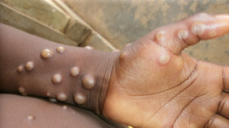 Guinée. L’ANSS suspecte neuf cas de Mpox